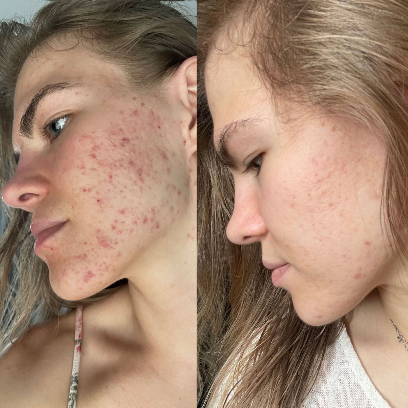 Antes y después del cuidado de una piel con brotes